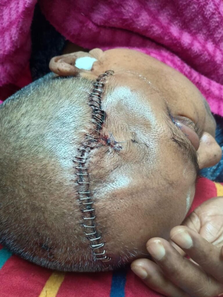 Suture removal at home in Bangalore by a qualified